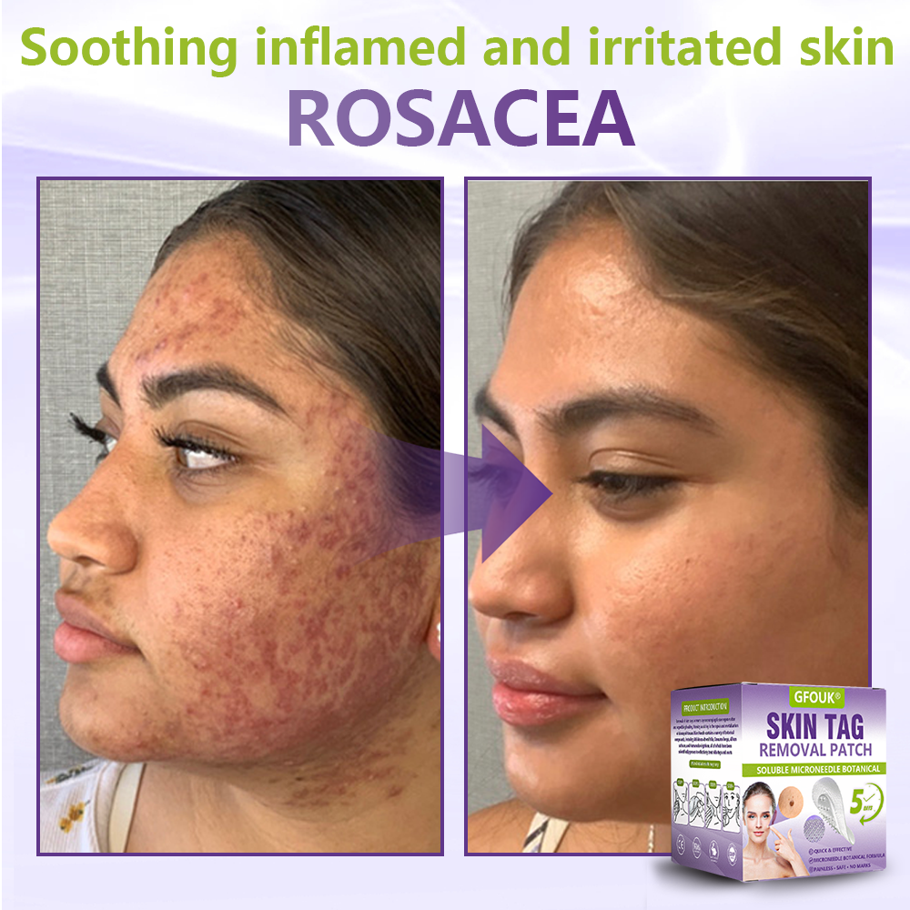 Made and Shipped from Australian ✨GFOUK® Soluble Microneedle Botanical Skin Tag Removal Patch🦘 -up