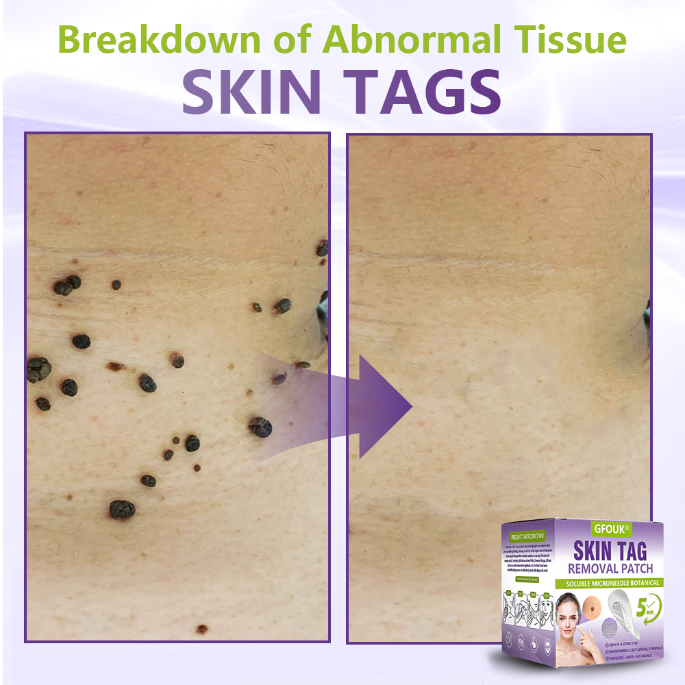 Made and Shipped from Australian ✨GFOUK® Soluble Microneedle Botanical Skin Tag Removal Patch🦘 -up