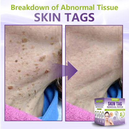 Made and Shipped from Australian ✨GFOUK® Soluble Microneedle Botanical Skin Tag Removal Patch🦘 -up